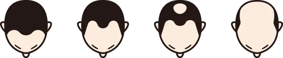 生え際から薄毛が進行していくイメージ